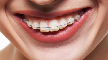 Weigering stout Samuel Orthodontie bij volwassenen - Orthodontie Kortrijk